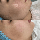 BioRePeel Professional Peels BioRePeel FND 35% Peel Ampoules 5 x 6ml