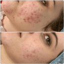 BioRePeel Professional Peels BioRePeel FND 35% Peel Ampoules 5 x 6ml