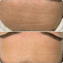 BioRePeel Professional Peels BioRePeel FND 35% Peel Ampoules 5 x 6ml