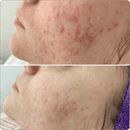 BioRePeel Professional Peels BioRePeel FND 35% Peel Ampoules 5 x 6ml